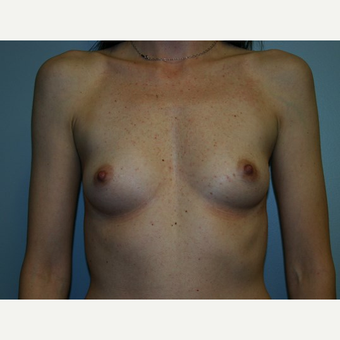 Breast Augmentation before 3562000
