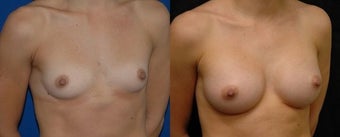 22 year old woman treated with Breast Augmentation before 3004704