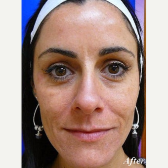35-44 year old woman treated with Laser Resurfacing after 3710782