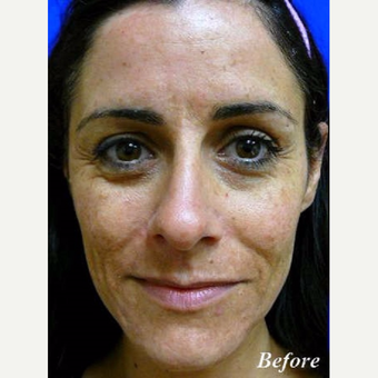 35-44 year old woman treated with Laser Resurfacing before 3710782