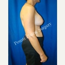 45-54 year old woman treated with Breast Implant Removal 1556532