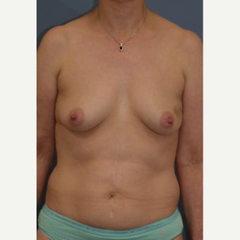 Nipple Sparing Mastectomy and "Scarless" Latissimus/Expander Breast Reconstruction before 1859038