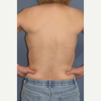 Nipple Sparing Mastectomy and "Scarless" Latissimus/Expander Breast Reconstruction 1859038