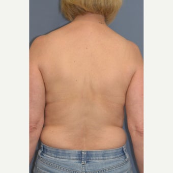 Nipple Sparing Mastectomy and "Scarless" Latissimus/Expander Breast Reconstruction 1859038