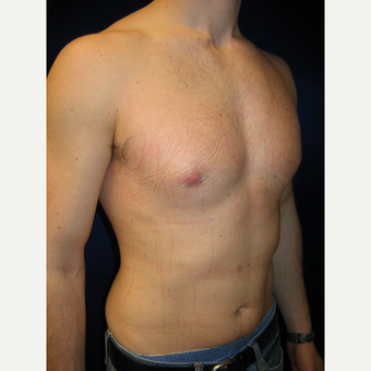 35-44 year old man treated with Male Breast Reduction after 3727275
