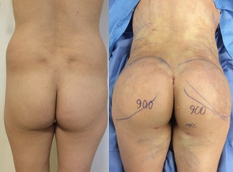 Brazilian Butt Lift - For Square Deformity before 1511901