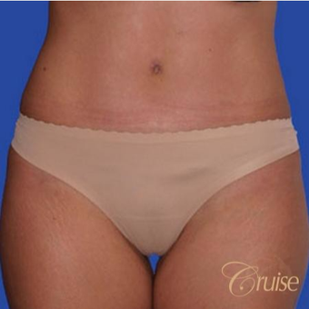 32 year old woman treated with a Standard Tummy Tuck after 3584869