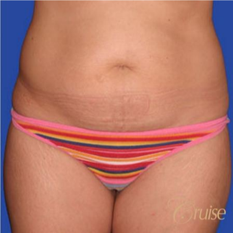 32 year old woman treated with a Standard Tummy Tuck before 3584869