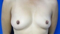 Breast Augmentation before 3054786