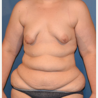 35-44 year old woman treated with Breast Fat Transfer before 3132099