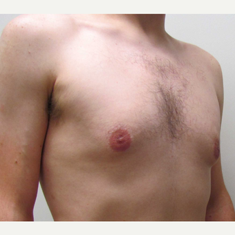 Male Breast Reduction for this 25 Year Old Man before 3042766