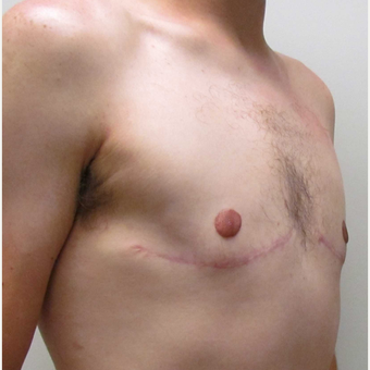 Male Breast Reduction for this 25 Year Old Man after 3042766