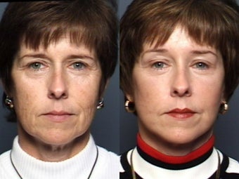 Brow Lift before 338631