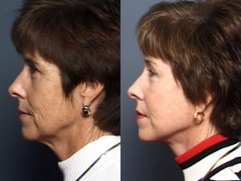 Brow Lift 338631
