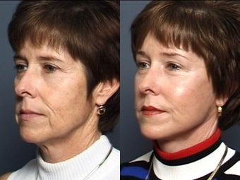 Brow Lift after 338631