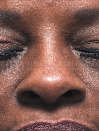 Woman treated with Non Surgical Nose Job 1538943