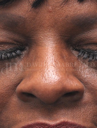 Woman treated with Non Surgical Nose Job 1538943