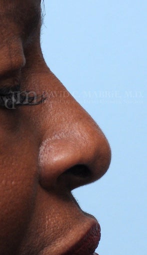 Woman treated with Non Surgical Nose Job before 1538943
