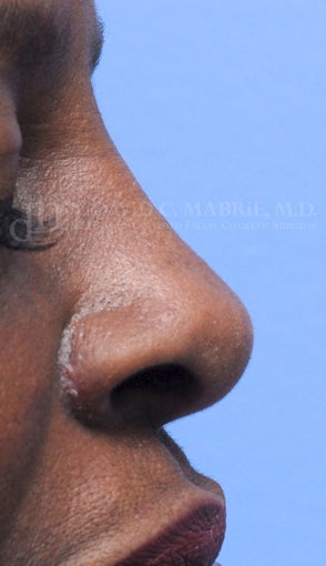 Woman treated with Non Surgical Nose Job after 1538943