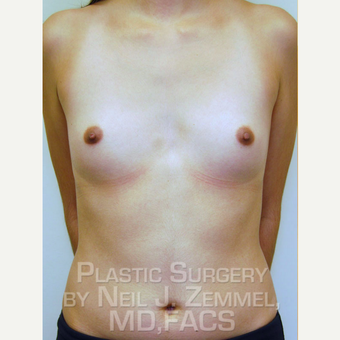 18-24 year old woman treated with Breast Augmentation before 2842502