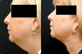 Smart Lipo: Chin Area before 989024