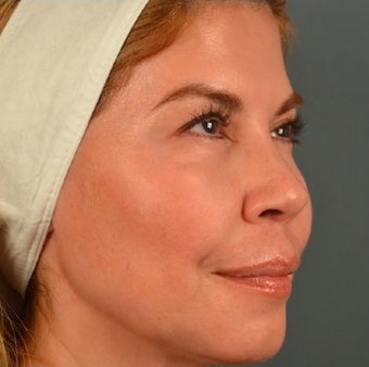 45-54 year old woman treated with Thermage 1687853