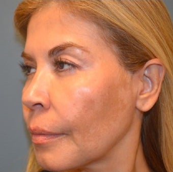 45-54 year old woman treated with Thermage before 1687853