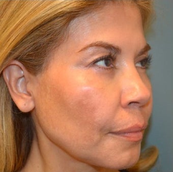45-54 year old woman treated with Thermage 1687853