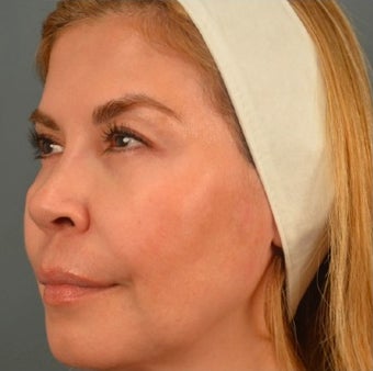45-54 year old woman treated with Thermage after 1687853