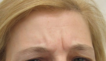 40 year-old female treated with Botox for frown lines before 989329