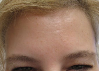 40 year-old female treated with Botox for frown lines after 989329