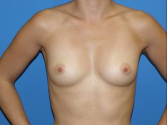 Breast Augmentation before 271016