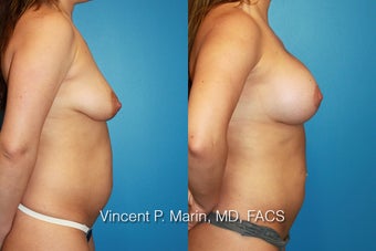 Breast Augmentation and Lift after 990831