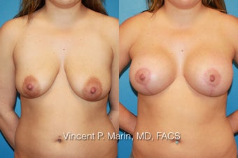 Breast Augmentation and Lift before 990831