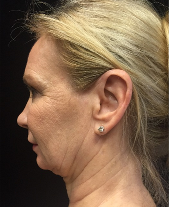 45-54 year old woman treated with ThermiTight before 2114464
