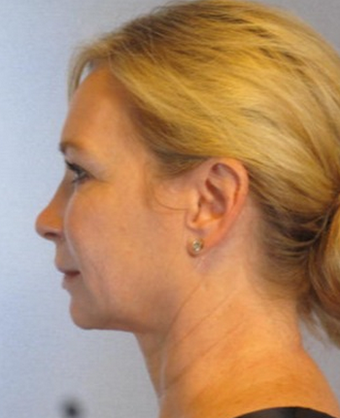 45-54 year old woman treated with ThermiTight after 2114464