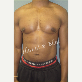35-44 year old body builder treated with Male Breast Reduction (Gynecomastia surgery) after 3327253