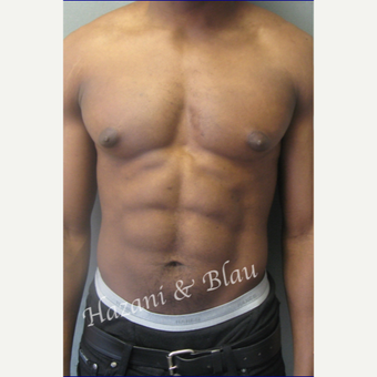 35-44 year old body builder treated with Male Breast Reduction (Gynecomastia surgery) before 3327253