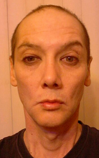 Facial Feminization Rhinoplasty and VY Lip Advancement after 1423805