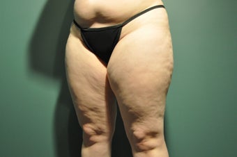 Cellulaze before 1098307