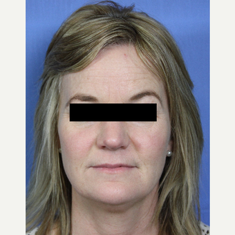 45-54 year old woman treated with Voluma, Juvederm, Botox, Kybella and ZO skin care products before 3215302