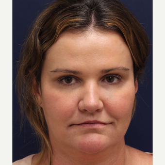 18-24 year old woman treated with Bellafill before 3143454