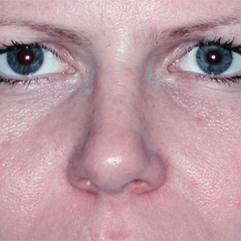 25-34 year old woman treated with Facial Reconstructive Surgery after 3714677