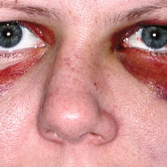 25-34 year old woman treated with Facial Reconstructive Surgery before 3714677