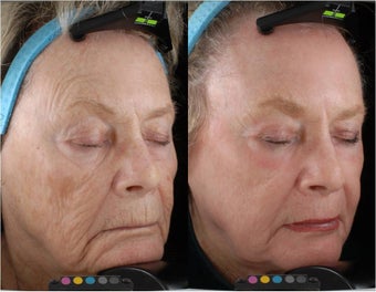 Pigmentation after 722750