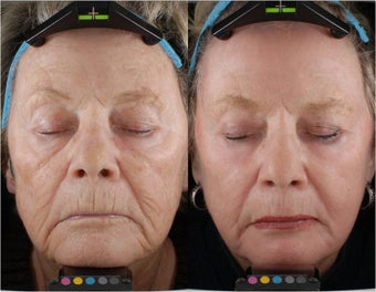 Pigmentation before 722750
