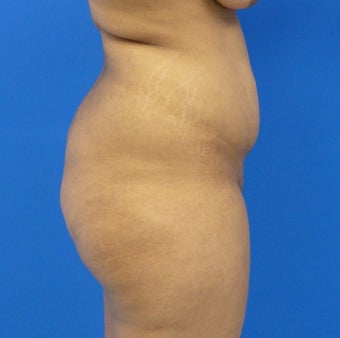 27 y.o. female – Liposuction of abdomen, flanks, and back with fat transfer to buttocks & hips– 1300cc per side 1440558