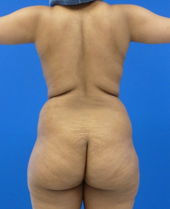 27 y.o. female – Liposuction of abdomen, flanks, and back with fat transfer to buttocks & hips– 1300cc per side before 1440558