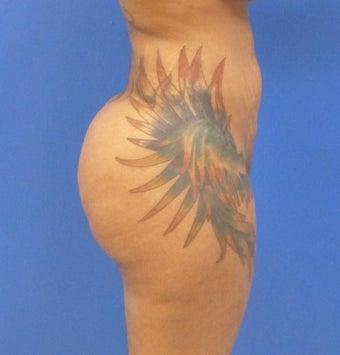 27 y.o. female – Liposuction of abdomen, flanks, and back with fat transfer to buttocks & hips– 1300cc per side 1440558
