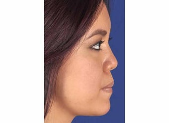 Chin Enhancement after 1357229